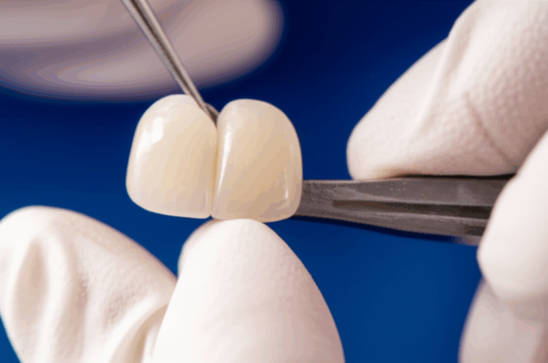 Can Porcelain Veneers Be Reshaped Understanding Your Options for Adjustment and Repair