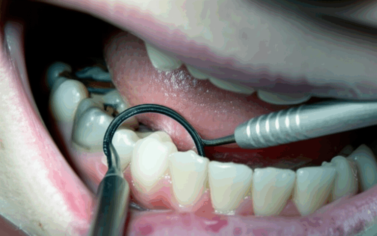 Why Dental Calculus Tartar Is a Major Concern for Every Dentist My Personal Experience