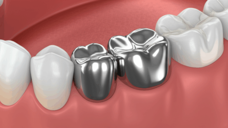 Why Do Dentists Use Silver Caps on Teeth Understanding Amalgam Stainless Steel and Metal Crowns